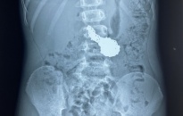Bệnh viện Quốc tế Sản nhi Hải Phòng kịp thời gắp dây chuyền bạc trong ổ bụng của bệnh nhi 6 tuổi