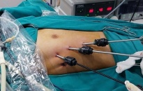 Bệnh viện Trẻ em Hải Phòng: Phẫu thuật nội soi điều trị tràn khí màng phổi do vỡ kén khí 