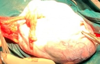 Bệnh viện Trẻ em Hải Phòng: Phẫu thuật thành công cắt bỏ khối u buồng trứng nặng hơn 6kg cho bé gái 9 tuổi 