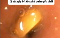 Bệnh viện Trẻ em Hải Phòng: Liên tục xử trí thành công dị vật đường thở