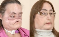 Người phụ nữ ghép mặt đầu tiên ở Mỹ lộ diện