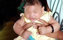 Việt Nam ghi nhận em bé đầu tiên mắc chứng đầu nhỏ do virus Zika